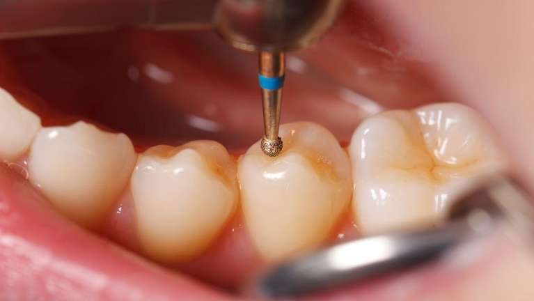 Dental Filling in Smyrna, GA 30080
