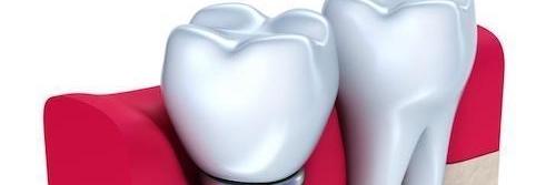 close up of dental implant l best dentist smyrna ga