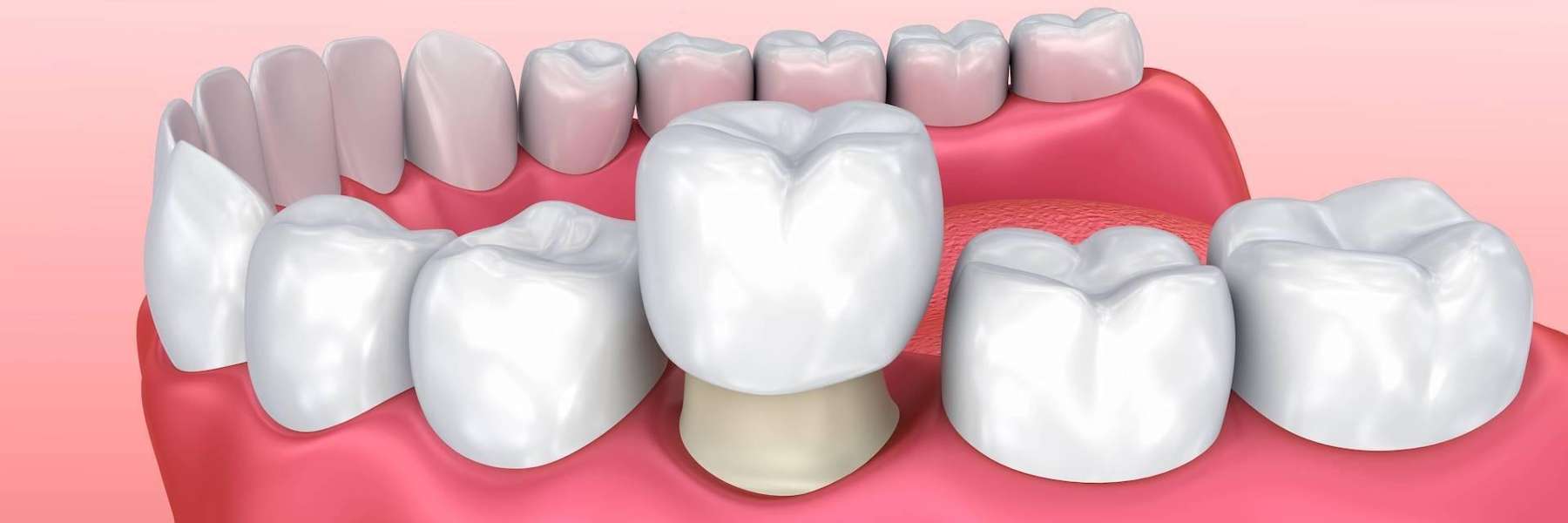 dental crown illustration in Smyrna, GA